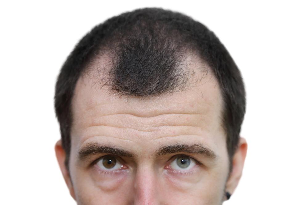 Treatment Options for Hair Loss